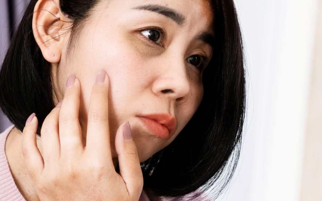 Donkere kringen onder uw ogen? Dit kunt u ertegen doen